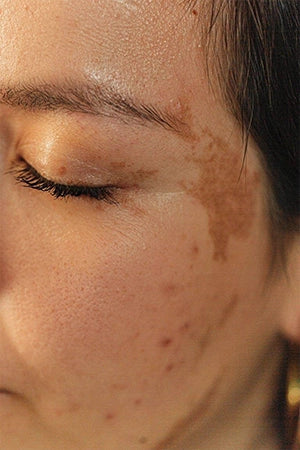 Hyperpigmentation Treatment