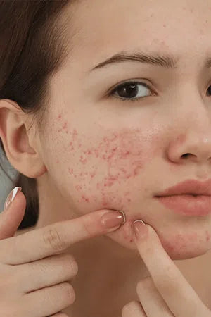 Acne Treatment