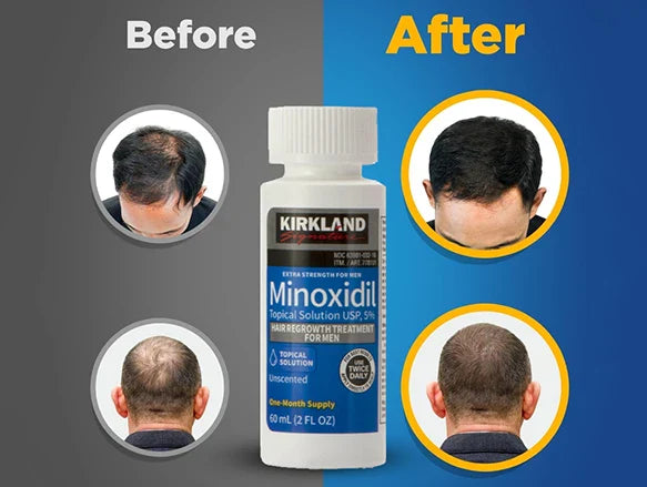 Kirkland Minoxidil 5% Extra Strength Hair Regrowth Treatment for Men in Sri Lanka