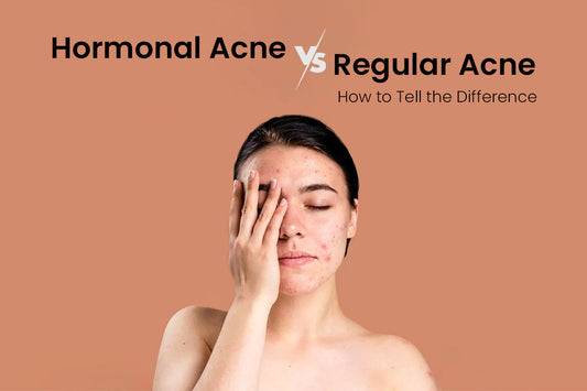 Hormonal Acne vs Regular Acne – How to Tell the Difference