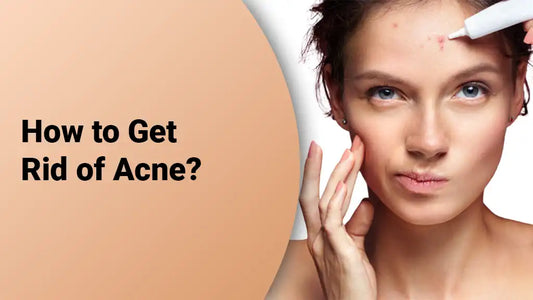 How to Get Rid of Acne?