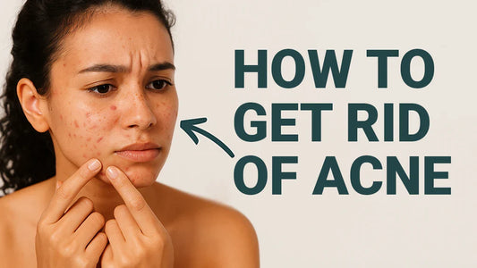 How to Get Rid of Acne?