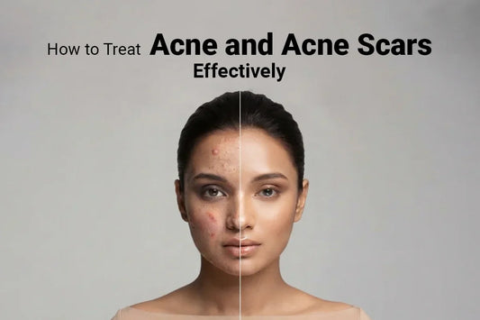 How to Treat Acne and Acne Scars Effectively