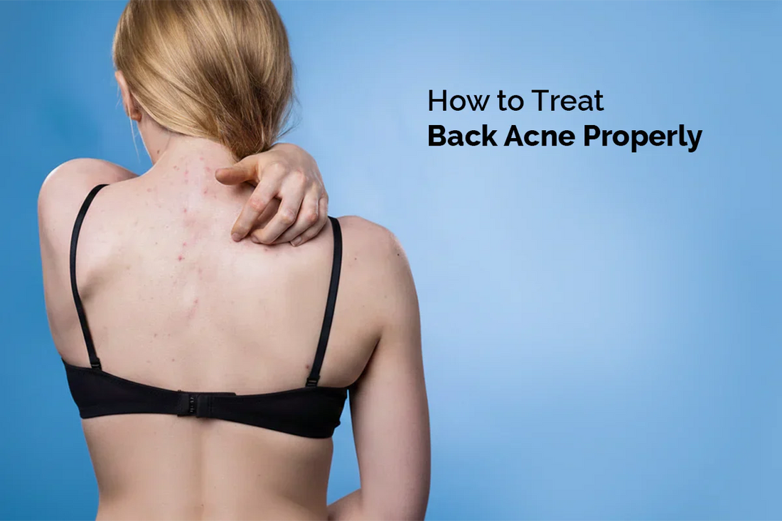 How to Treat Back Acne Properly