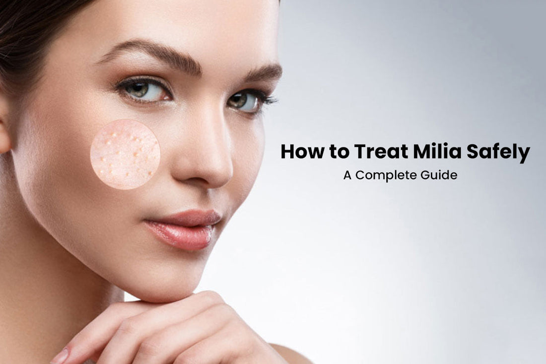 How to Treat Milia Safely: A Complete Guide