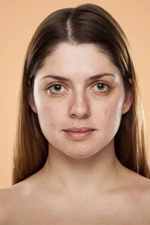 Dull Skin Treatment
