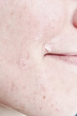 Skin Dryness Treatment