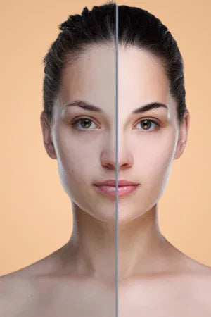 Uneven Skin Treatment