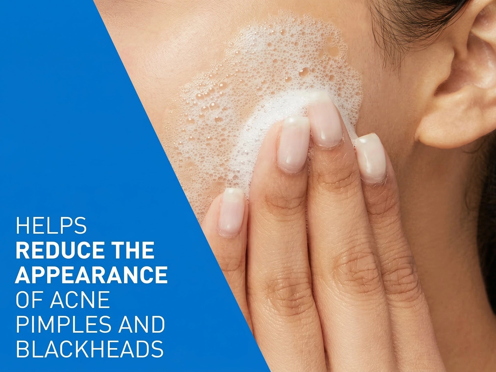 Cerave Acne Control Cleanser 236ml - USA in Sri Lanka