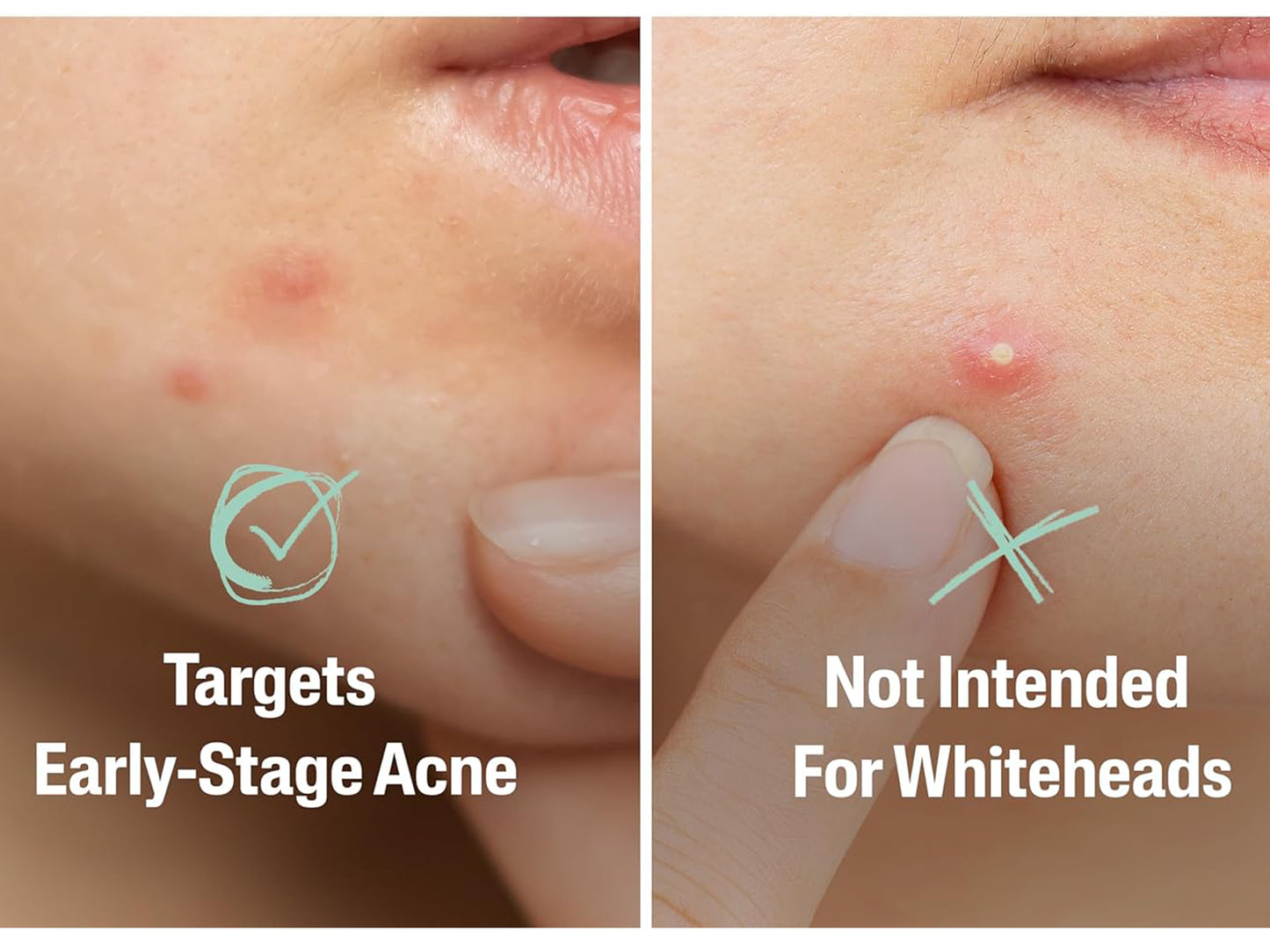Cetaphil Fast Rescue Pimple Patch in Sri Lanka