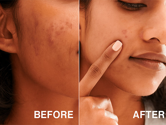 Buy Original Neutrogena Oil-free Acne Wash 269ml in Sri Lanka