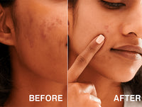 Buy Original Neutrogena Oil-free Acne Wash 269ml in Sri Lanka
