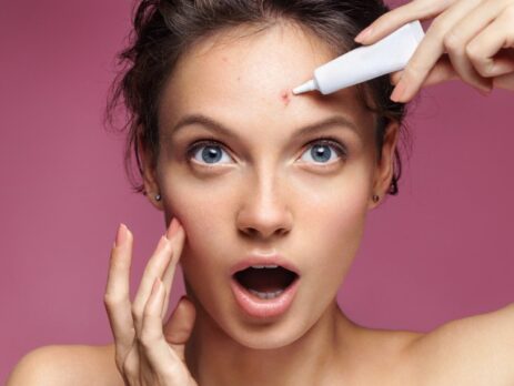 How to get Rid of acne -Cosmetics.lk